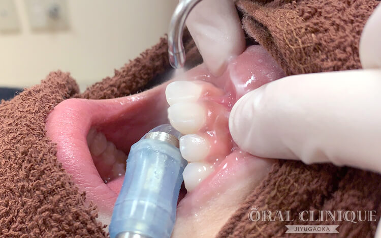 歯のクリーニング　超音波イオン　ステイン除去