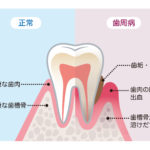 自由が丘 歯医者 歯周病