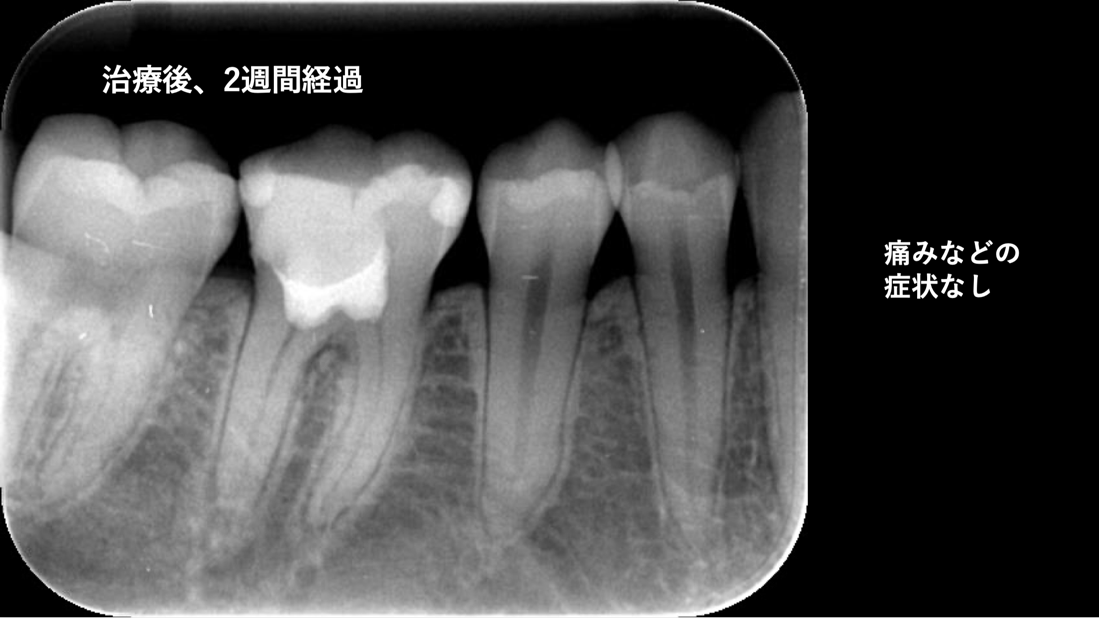 生活歯髄療法2週間後 自由が丘 歯医者