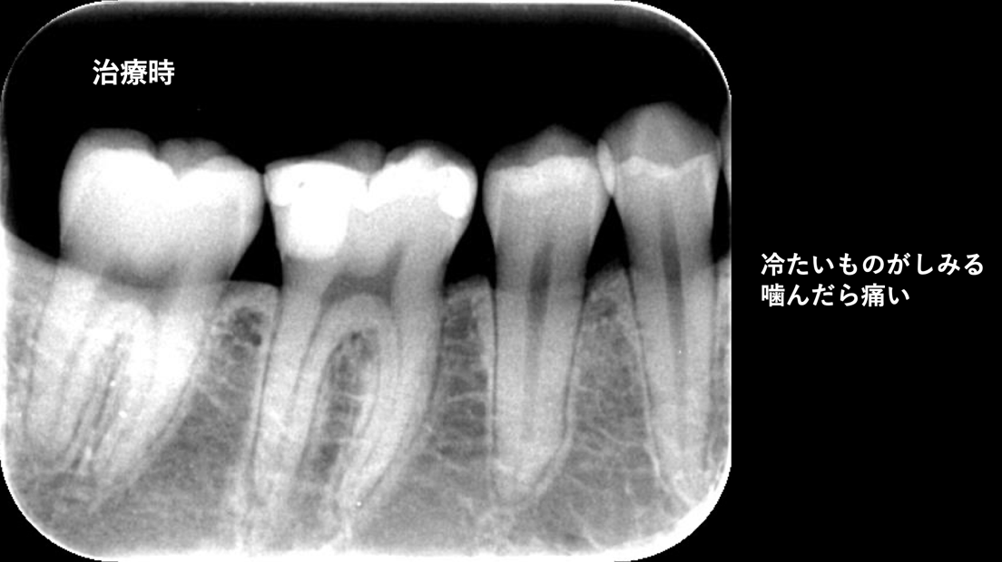 生活歯髄療法の治療前 自由が丘 歯医者