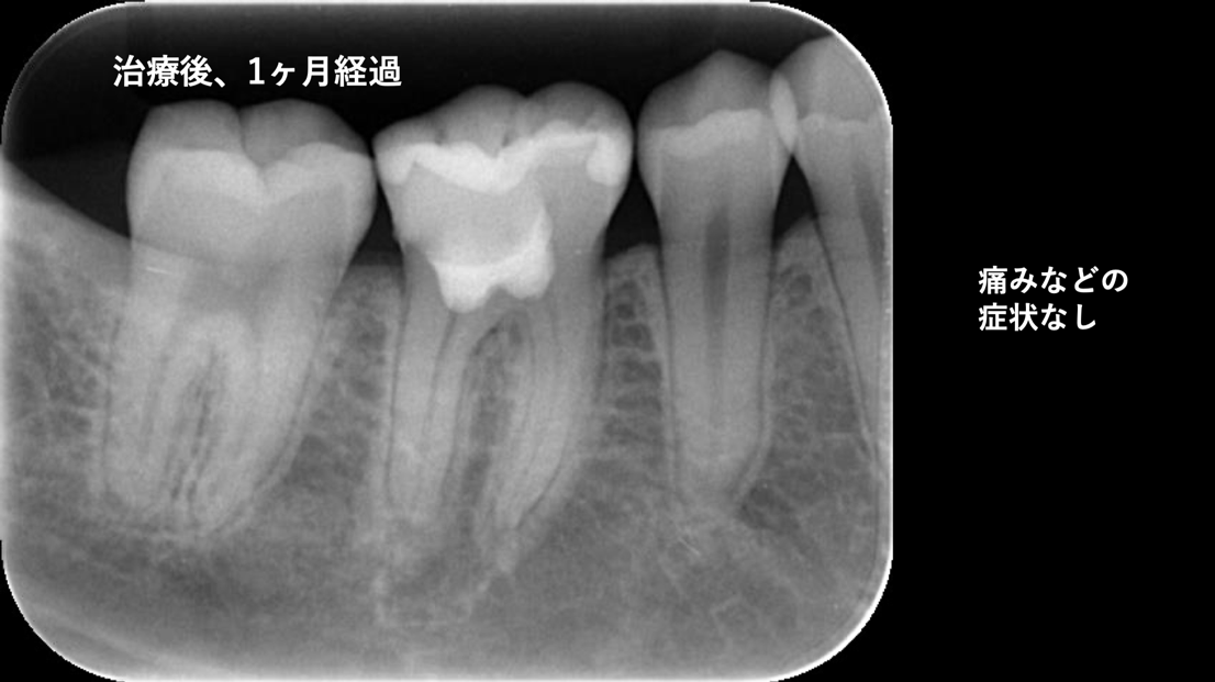 生活歯髄療法1か月後 自由が丘 歯医者