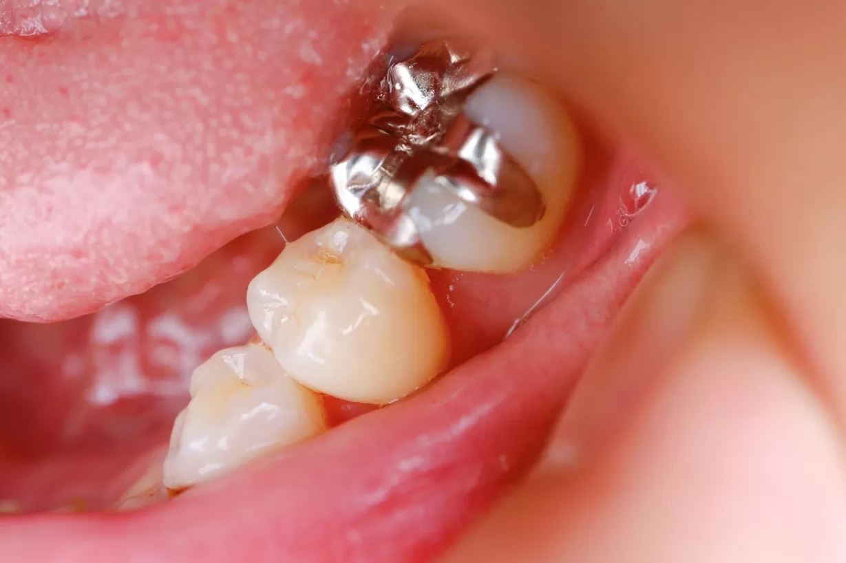 銀歯とセラミックの違い｜東京・自由が丘の歯医者